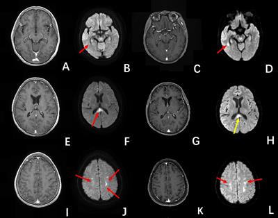 Case report: Intravascular large B cell lymphoma mimicking acute demyelinating encephalomyelitis after SARS-CoV-2 reinfection: diagnostic value of advanced MRI techniques and the literature review with the assistance of ChatGPT